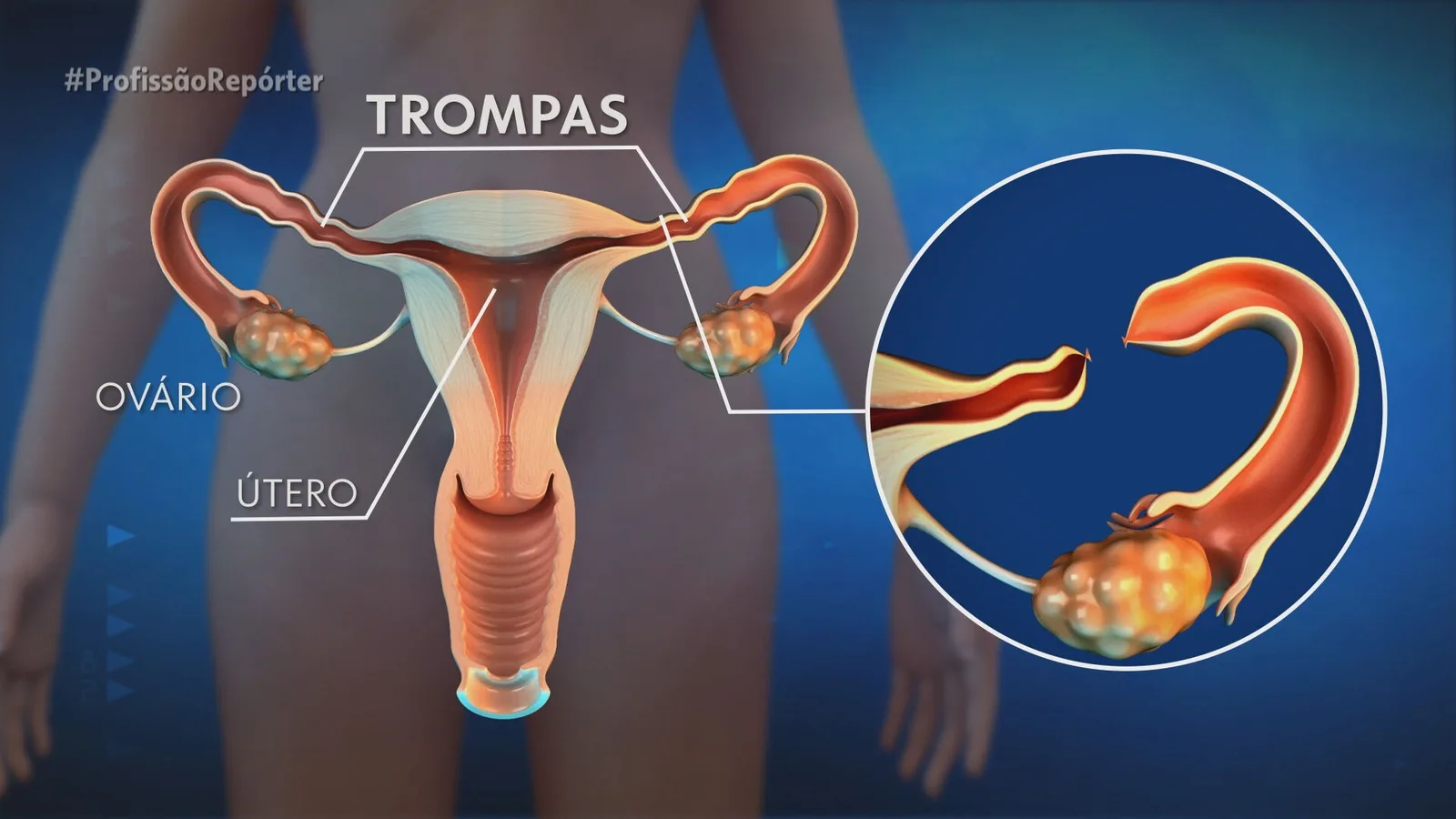 Laqueadura exige consentimento e pode ser realizada após 21 anos